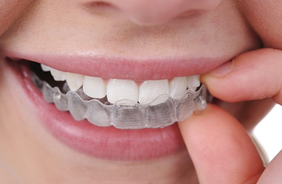 举个栗子：矫正牙齿什么年龄最合适？