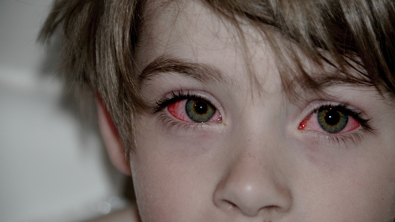 举个栗子：预防”红眼病“，你该怎么做？