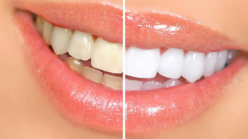 举个栗子：牙齿越白越健康？